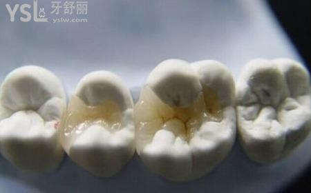 嵌體的優(yōu)缺點(diǎn)是哪些？