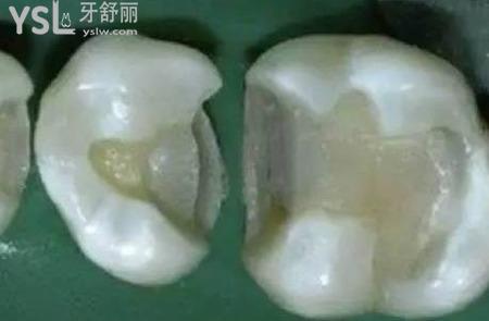 嵌體是怎么制作的？