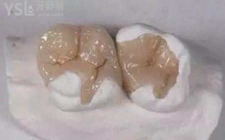 嵌體和牙套哪個(gè)好？
