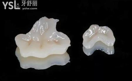 什么是牙體缺損的嵌體修復(fù)？