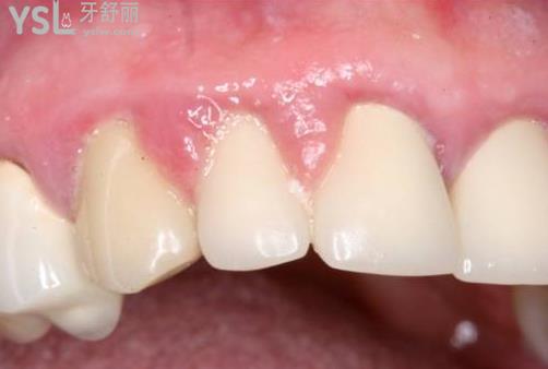 牙齦增生洗牙后就會(huì)好嗎？