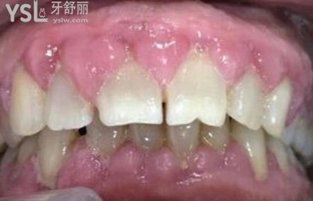 小孩牙齦增生要割掉嗎？