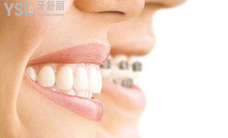 一般牙齒正畸的年齡限制是多少？