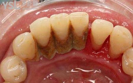 牙周膿腫吃藥有用嗎？