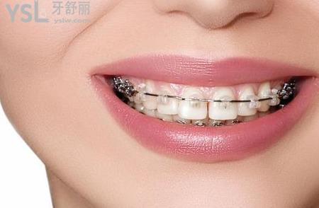 牙齒正畸是什么意思？