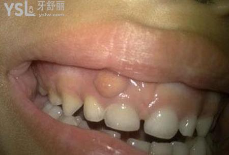 牙上面起個(gè)膿包怎么辦？