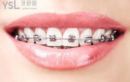 傳統(tǒng)牙齒矯正器什么樣子？