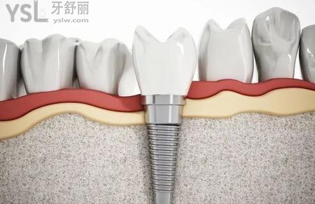 牙種植是指什么？