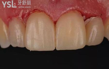 什么是全瓷貼面修復(fù)？