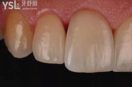 瓷貼面修復(fù)后的注意事項(xiàng)？