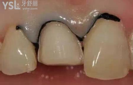 瓷貼面容易掉嗎？