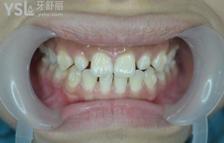 什么癥狀比較適合做瓷貼面？