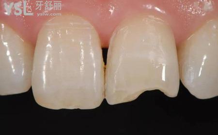 瓷貼面修復(fù)有哪些優(yōu)勢(shì)？