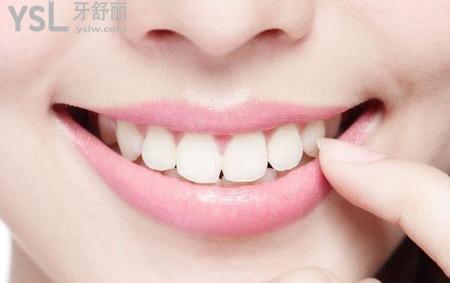 瓷貼面后該怎么自我維護(hù)和保養(yǎng)？