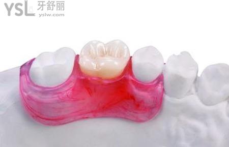 活動(dòng)義齒幾天能裝？