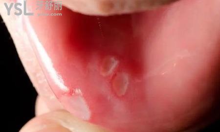 為什么最近老是口腔潰瘍？