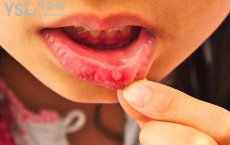 口腔潰瘍是什么樣的？