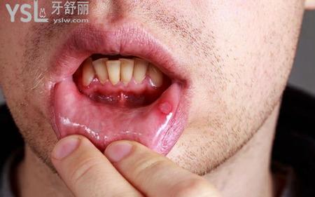 為什么容易口腔潰瘍？