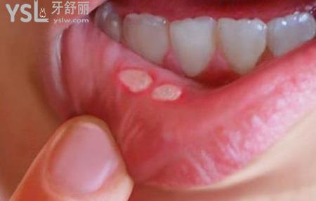 口腔潰瘍好不了是怎么回事？