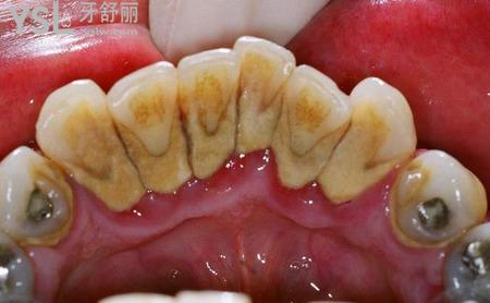 自己怎么除牙結(jié)石？