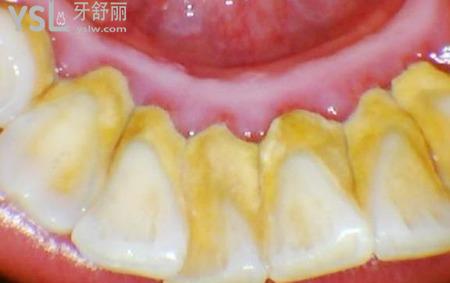 怎么防止牙結(jié)石？