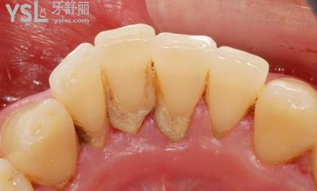 牙結(jié)石的危害都有什么危害？