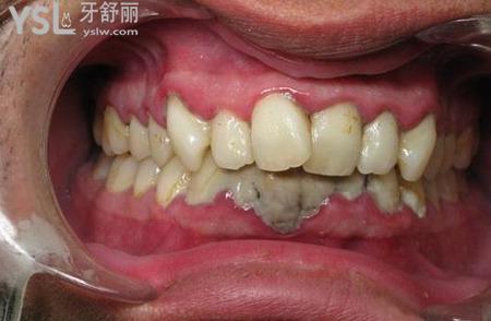 牙結(jié)石用什么牙膏好？