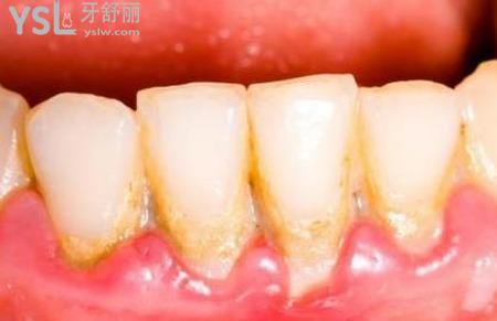 牙結(jié)石怎么治療？
