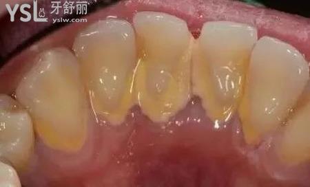 除牙結(jié)石的好方法有哪些？