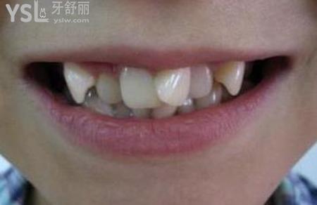 長(zhǎng)歪牙有什么危害？
