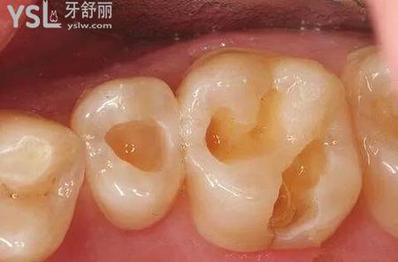 補牙為什么疼？