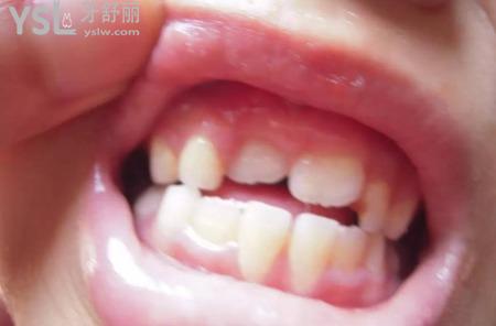 換牙時(shí)新牙長(zhǎng)歪了怎么辦？
