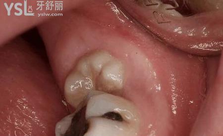 智齒長(zhǎng)歪了怎么治？