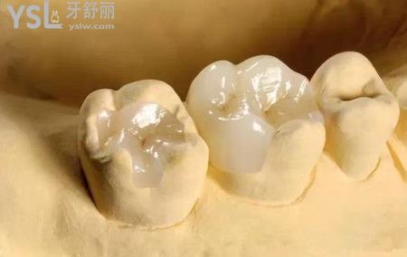 嵌體修復(fù)的優(yōu)勢(shì)是什么？