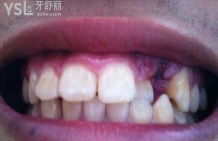 有一顆牙齒長(zhǎng)歪了怎么辦？