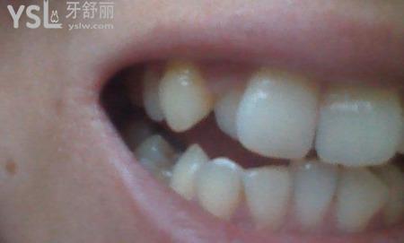 30歲牙齒突然長(zhǎng)歪了怎么回事？