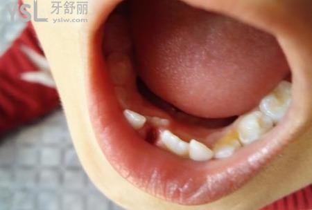 寶寶牙齒長(zhǎng)歪了如何矯正？