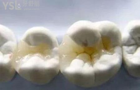 嵌體修復(fù)的禁忌癥是什么？