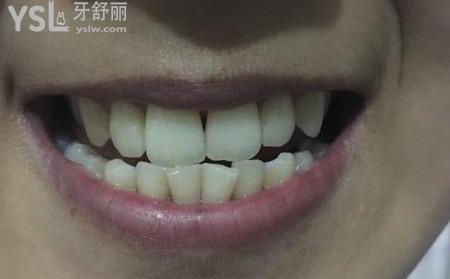 牙齒歪怎么辦？