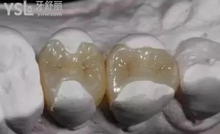 什么是牙齒嵌體修復(fù)？