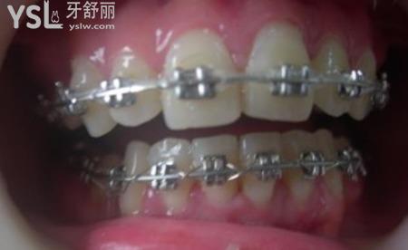 隱形正畸和傳統(tǒng)正畸區(qū)別在那里？