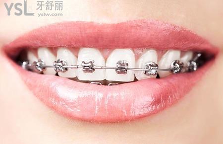 為什么要拔牙正畸？