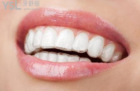 正畸一般要多久？