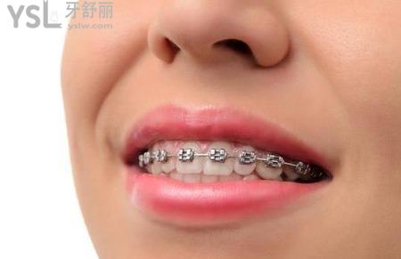 成年人的矯正治療與兒童矯正治療有何不同？