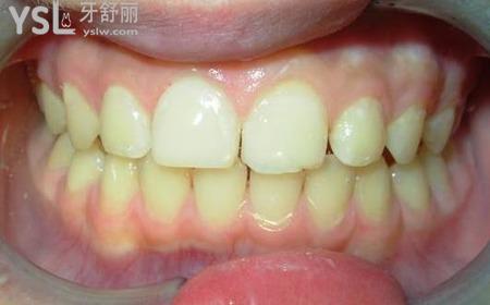 洗牙有沒有必要噴砂？