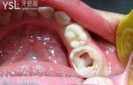 怎么知道是不是牙髓炎？