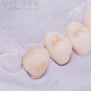 拉瓦全瓷牙一顆價(jià)格？