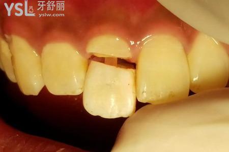 帶牙套后牙根斷怎么辦？