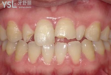 牙齒外傷掉了怎么處理？