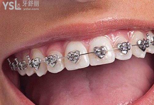 自鎖托槽牙齒矯正疼嗎？